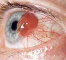 Увеялния меланома, или рак на окото: как да се идентифицират и лечение