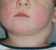 Увеличени лимфни възли в областта на шията на детето. Причини и лечение.