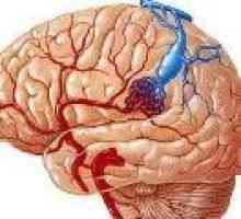 Венозна ангиома на мозъка (малък мозък, фронтален лоб)