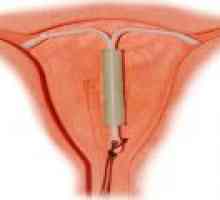 ВМУ като форма на контрацепция