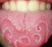 Възпаление на езика (глосит) - причини, диагностика, лечение