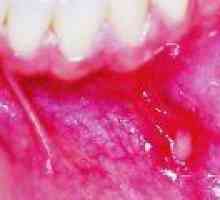Възпаление на устната кухина: причинява лечението