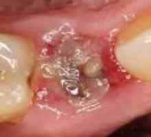 Възпаление след изваждане на зъб, лечение с антибиотици