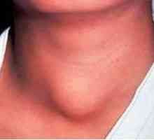 Възпаление на щитовидната жлеза (тиреоидит): симптоми и лечение