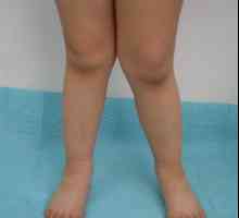 Вродена дисплазия на коляното