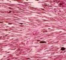 Характеристики откриване и лечение вретено клетка меланома
