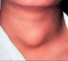 Заболяване на щитовидната жлеза при жените - Лечение