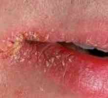 Perleches ъглите на устата: симптоми, причини, лечение