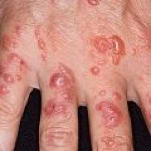 Актинична дерматит: причини, симптоми, лечение