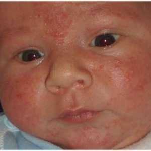 Алергичен обрив при деца
