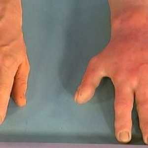 Алергия към студ: неприятни симптоми на студа