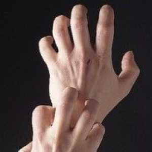 Алергия към ръце, причини, лечение