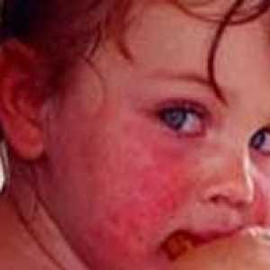 Алергия към сладко при деца, при възрастни, лечение