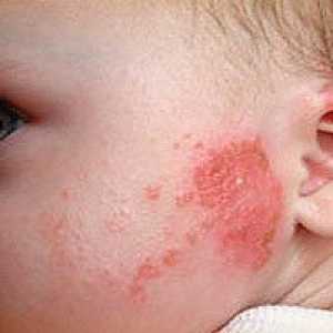 Алергия при кърмачета, причини, симптоми, лечение