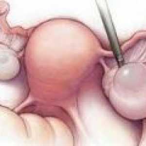 Яйчниците апоплексия: причини, симптоми, лечение