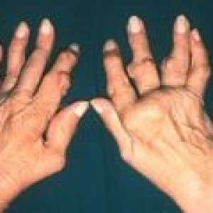 Артрит на ставите на пръстите на ръцете: симптоми и лечение