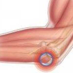 Остеоартрит на коляното: как да се лекува?