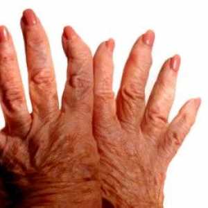 Артроза на пръстите, симптоми и лечение