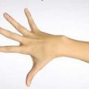 Артроза на пръстите на ръцете, ставите на пръстите на ръцете, как да се лекуват?