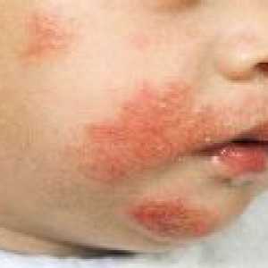 Атопичен дерматит при бебета - симптоми, лечението с