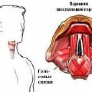 Болки в гърлото при преглъщане поради ларингит