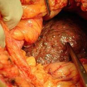 Цироза на черния дроб - главния симптоми, видове и лечение tsiroz