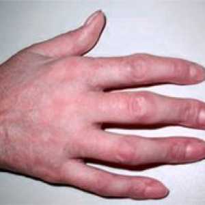 Деформацията на пръста