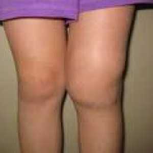 Деформирайки артроза на колянната става