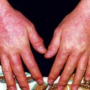 Диагностика и лечение на алергичен дерматит