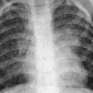 Дисеминирана туберкулоза: причини, симптоми, лечение