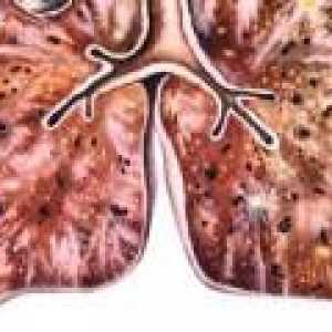 Дисеминирана туберкулоза: симптоми, лечение