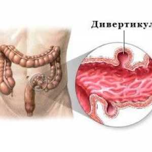 Дивертикулоза червата (дебелото черво) - симптоми и лечение