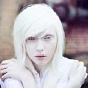 Oculocutaneous албинизъм: причини, симптоми, лечение