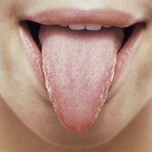 Глосит - възпаление на езика