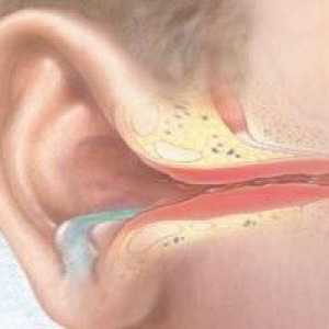 Гнойни възпаления на средното ухо - средна, остра, хронична, гнойни отити при деца, лечение