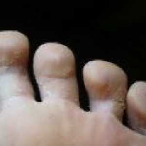 Крака гъбички - популярните методи на лечение