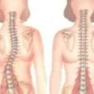 Herniated гръбначния SHmorlja: симптоми, лечение