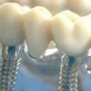Зъбните импланти: ключови факти