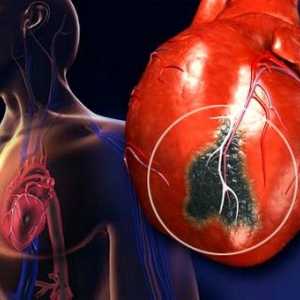 Сърдечен удар при мъжете, така и жените: симптомите и признаците на