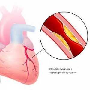 Коронарната болест на сърцето
