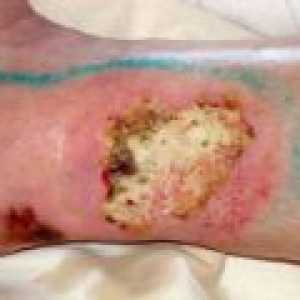 Как за лечение на рани по краката?