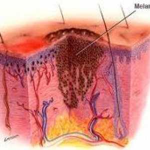 Как е диференциалната диагноза на меланома