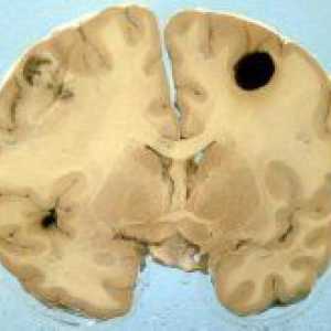 Как да разпознаем и лечение на меланом мозъка