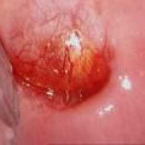 Рак на шийката на киста: причини и лечение