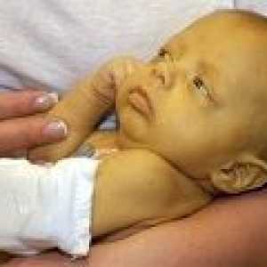 Конюгиране жълтеница при новородени: причини, симптоми, лечение