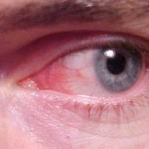Конюнктивит или червени очи: симптоми, лечение