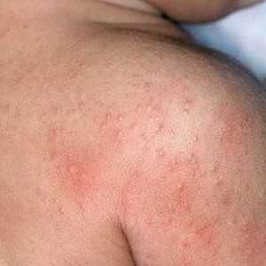 Алергия на кожата: причини, симптоми, лечение