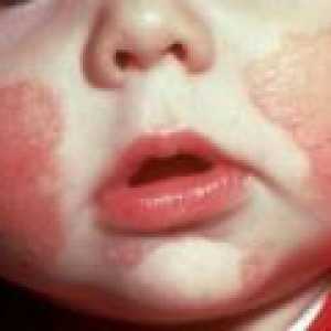 Уртикария при деца: симптоми, лечение