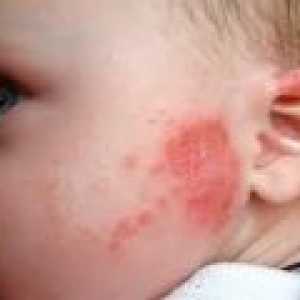 Червени петна по кожата на едно дете - причини, лечение