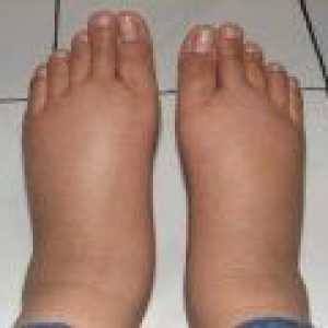 Лечение на отоци по краката при възрастни народни средства